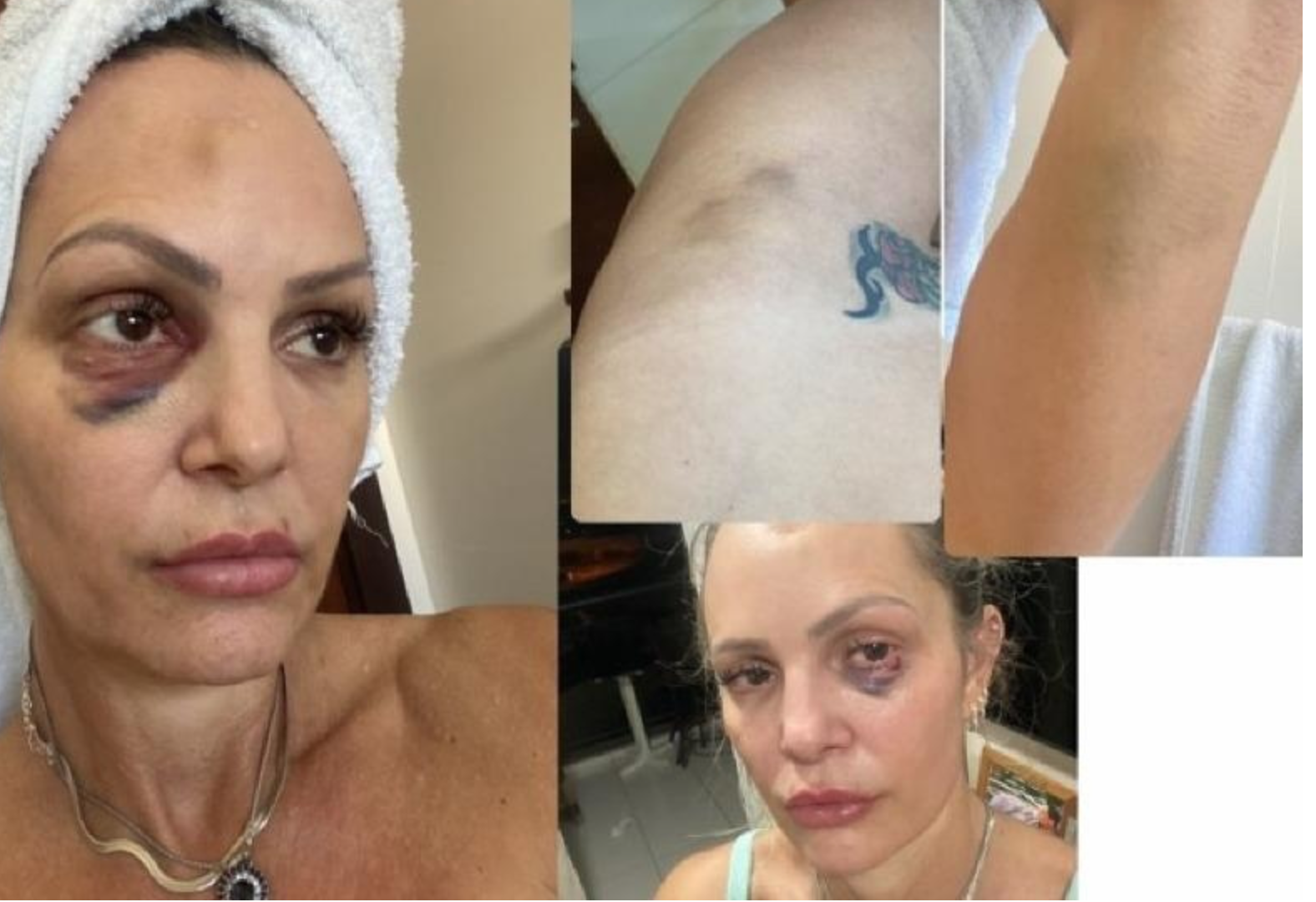 Personal trainer mostra hematomas de agressões sofridas por policial civil